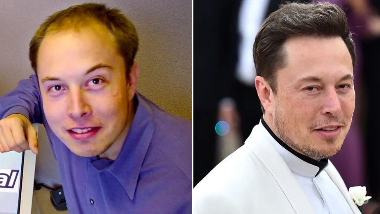 Everything About Elon Musk Hair Transplant