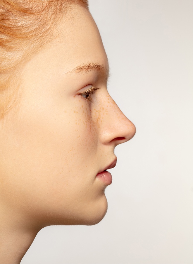 Rhinoplasty