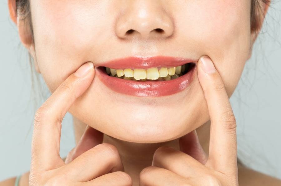 How to Get Rid of Yellow Teeth?