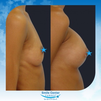 Breast-Augmentation