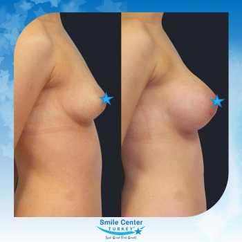 Breast-Augmentation