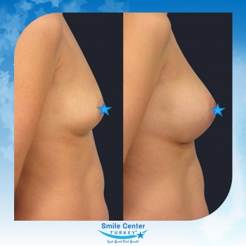 Breast-Augmentation