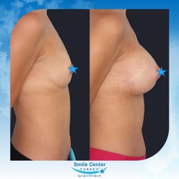 Breast-Augmentation