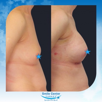 Breast-Augmentation