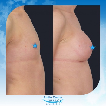 Breast-Augmentation