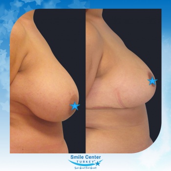 Breast-Reduction