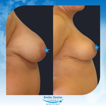 Breast-Reduction