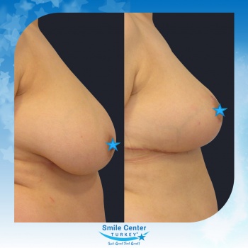 Breast-Reduction