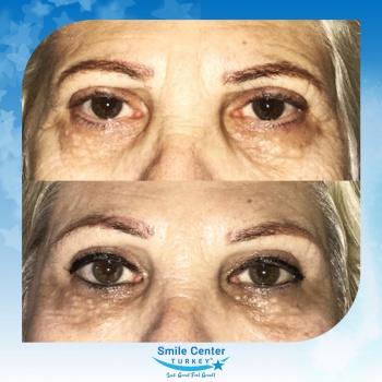 Eyelid-Surgery