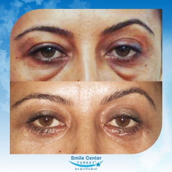 Eyelid-Surgery