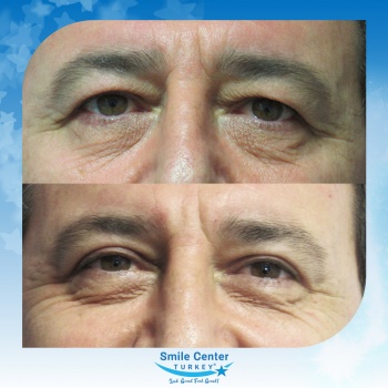 Eyelid-Surgery