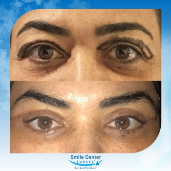 Eyelid-Surgery