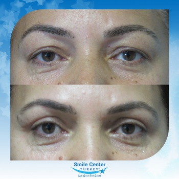 Eyelid-Surgery