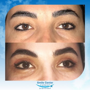 Eyelid-Surgery