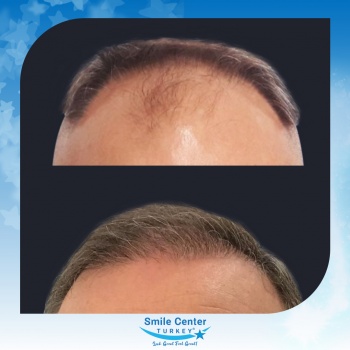 Hair-Transplant