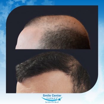 Hair-Transplant