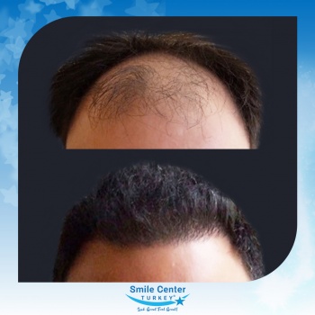 Hair-Transplant