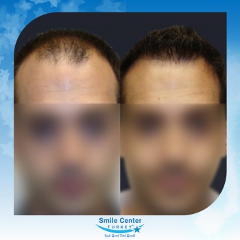 Hair-Transplant