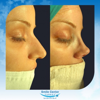 Rhinoplasty