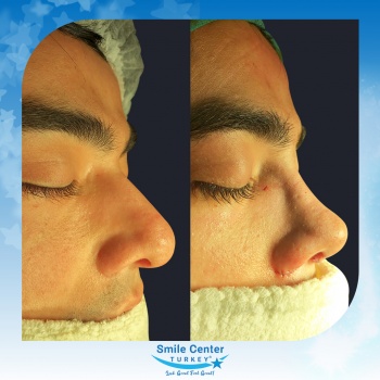 Rhinoplasty