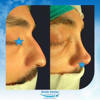 Rhinoplasty