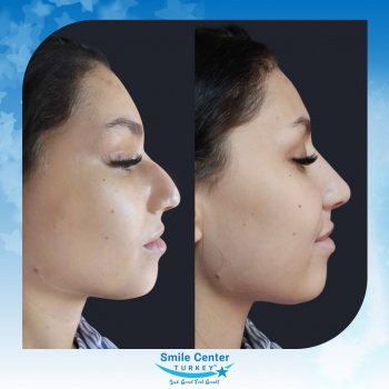 Rhinoplasty