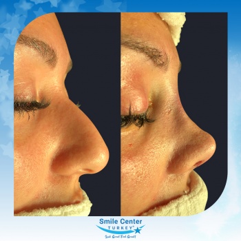 Rhinoplasty