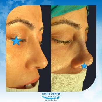 Rhinoplasty