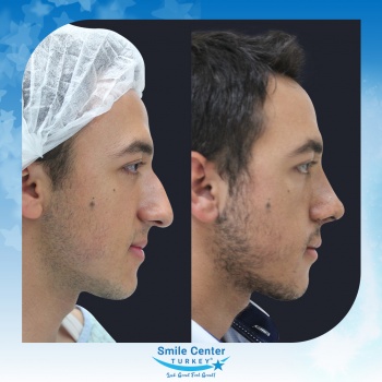 Rhinoplasty