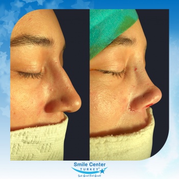 Rhinoplasty