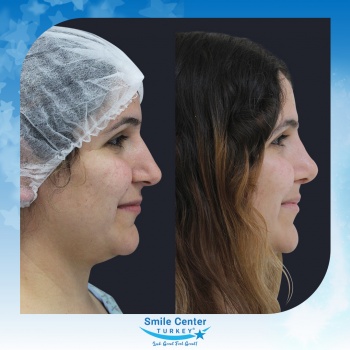 Rhinoplasty