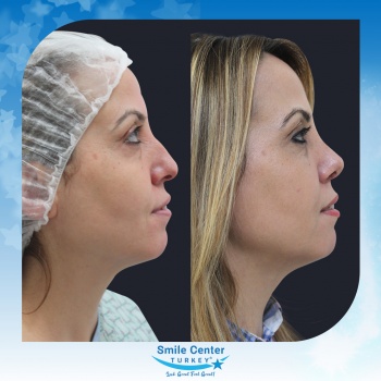 Rhinoplasty