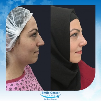 Rhinoplasty