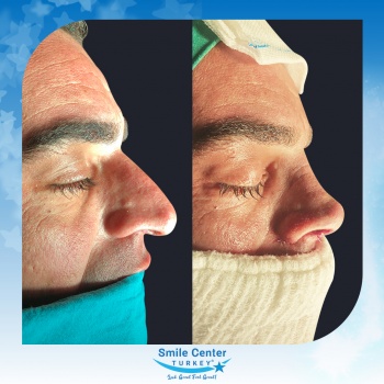 Rhinoplasty