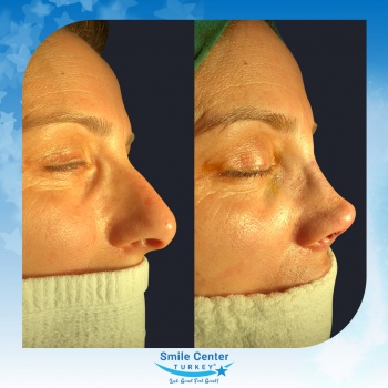 Rhinoplasty